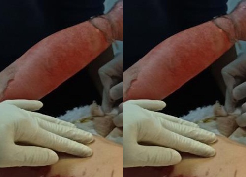 Hàng chục trẻ nhỏ bị thương do bị xịt hóa chất