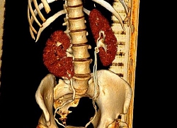 Phát hiện mình có 3 quả thận, nữ bệnh nhân quyết đoán làm điều này khiến ai cũng nể phục