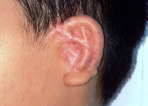 Thực hiện thành công kỹ thuật phẫu thuật tạo hình tai nhỏ microtia