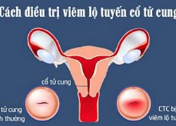 Điều trị viêm lộ tuyến cổ tử cung bằng 3 cách phổ biến hiện nay