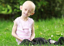 Phương pháp mới giúp chữa bệnh lão hoá sớm Progeria