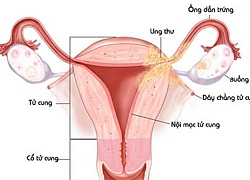 Bệnh vô sinh ở nữ giới gồm những nguyên nhân nào dễ gây vô sinh