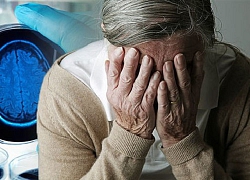 Mê sảng sau phẫu thuật có thể báo trước nguy cơ phát triển bệnh Alzheimer