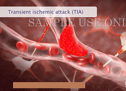 Trực quan cách một cơn đột quỵ xảy ra và tàn phá não bộ