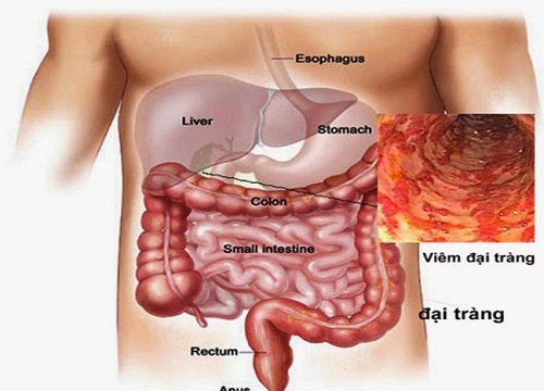 Những thực phẩm người bị viêm đại tràng mạn tính cần tránh