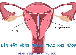 Thời điểm đặt vòng tránh thai là khi nào?