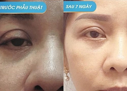 Công nghệ tái phẫu thuật mắt "3D Perfect Eyes Revision"