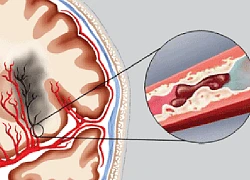 Nhồi máu não chiếm tỷ lệ khoảng 80-85% đột quỵ não