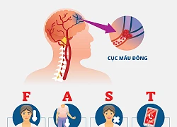 Cảnh báo: Đột quỵ não "tấn công" người trẻ