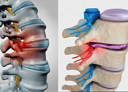 Thoát vị đĩa đệm cột sống thắt lưng