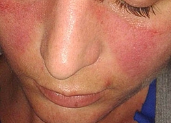 Israel và Mỹ tìm được cách chữa bệnh Lupus