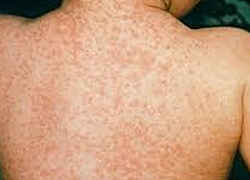 Kiến thức cần biết trước mùa bệnh sởi