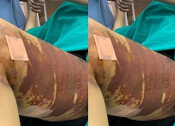 Nữ bệnh nhân bị tai biến khi hút mỡ tại thẩm mỹ viện Việt Hàn
