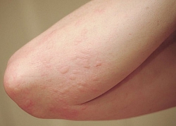 Trẻ bị mẩn ngứa, kiêng ăn gì?