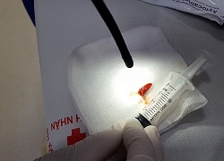 Mảnh ớt vướng trong phế quản suốt 2 tháng, suýt chẩn đoán nhầm ung thư phổi