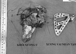 Đau vai suốt 5 năm, cô giáo tiểu học sốc khi phát hiện bị ung thư xương