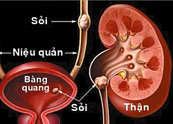 Phòng bệnh sỏi thận - tiết niệu