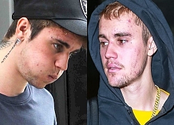 Bao năm bị tố lạm dụng ma tuý đá, Justin Bieber tiết lộ tình trạng bệnh tình thật sự khiến nhan sắc "tàn tạ"