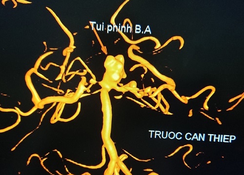 Cứu sống bệnh nhận bị vỡ túi phình mạch máu não nguy kịch