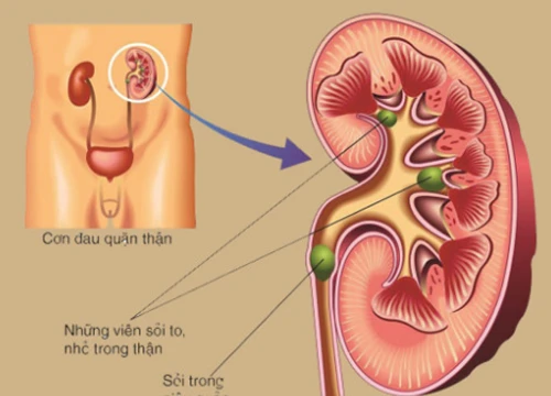 Cách điều trị sỏi thận hiệu quả và ít đau đớn