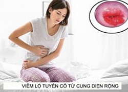 Viêm lộ tuyến cổ tử cung diện rộng có mang thai được không? Cần kiêng gì?