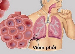 Đã có 3 nước châu Á ghi nhận bệnh viêm phổi lạ do vi rút corona