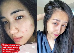 Mỹ nhân Vbiz tự &#8220;bóc trần&#8221; khuyết điểm: Hoà Minzy gây sốc với mặt mụn chi chít, Mai Phương Thuý như người khác với 0% make up