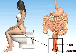 Dấu hiệu nhận biết bệnh trĩ