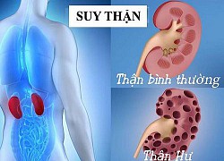 Cảnh báo gia tăng bệnh thận mạn tính trên toàn cầu