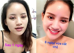 Bỏ tiền đi cắt mí, người phụ nữ nhận cái kết là đôi mắt không thể nhắm