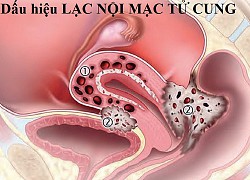 Lưu ý khi dùng thuốc điều trị lạc nội mạc tử cung