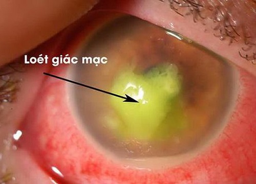 Viêm loét giác mạc nhiễm khuẩn: Nguy cơ cao gây mù lòa