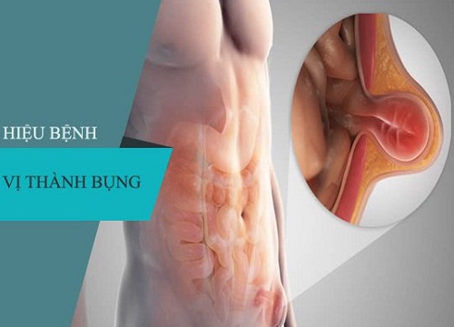 Nguy hiểm khi thoát vị thành bụng