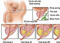 Ung thư tuyến tiền liệt không còn đáng sợ