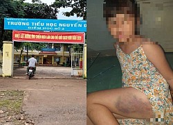 Bé gái lớp 3 bị đánh tím đùi xin mẹ tha thứ cho cô giáo: 'Con rất thương và muốn xin lỗi cô'