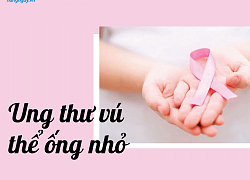 Ung thư vú thể ống nhỏ là gì? Chẩn đoán và điều trị như thế nào?