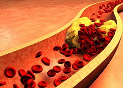 Người Việt thừa cholesterol do lười vận động