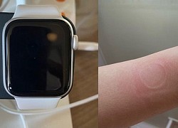 Đồng hồ "giá rẻ" Apple Watch SE khiến người dùng bị bỏng do quá tải nhiệt