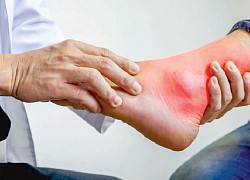 Không chủ quan điều trị bệnh gout