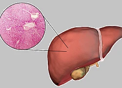 7 nhóm người có lá gan "phản chủ": Hãy cẩn thận vì nó đang xơ hóa, có thể dẫn đến ung thư