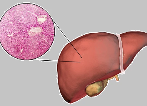 7 nhóm người có lá gan "phản chủ": Hãy cẩn thận vì nó đang xơ hóa, có thể dẫn đến ung thư