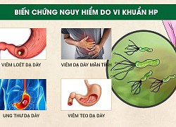 5 điều cần làm để ngừa ung thư dạ dày