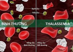 Cần quan tâm phòng ngừa bệnh Thalassemia