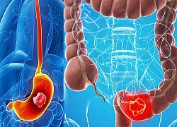 Sụt cân, đi ngoài ra máu, người đàn ông bất ngờ mắc 2 bệnh ung thư