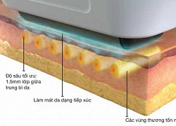 Công nghệ trẻ hóa da Intense Ultrasound Beam