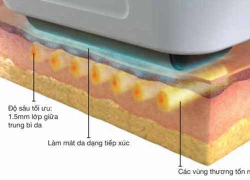 Công nghệ trẻ hóa da Intense Ultrasound Beam