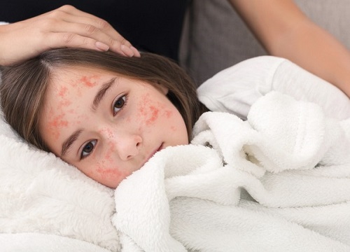 Dựa vào dấu hiệu bệnh sởi để phân biệt với sốt phát ban, Rubella và thuỷ đậu