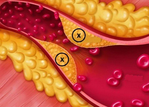 Dấu hiệu rối loạn lipid máu