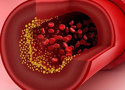 Khi cơ thể thừa cholesterol