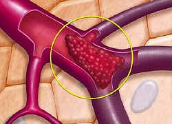 Huyết khối tĩnh mạch não: Bệnh nguy hiểm, cần phát hiện sớm